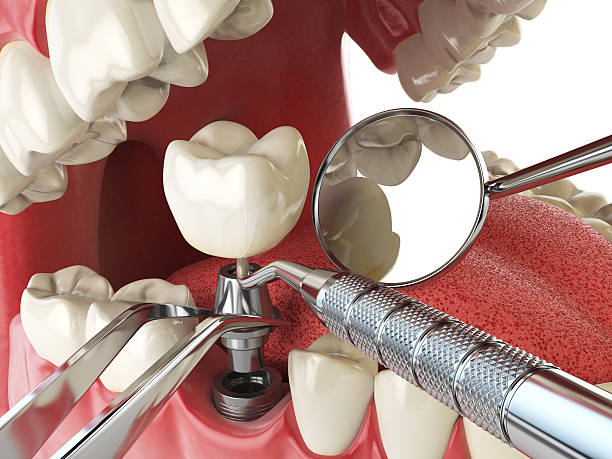 Best Emergency Dental Filling Replacement  in Tuscola, IL